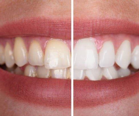 1+1 FREE I V34 Colour Corrector | Feel more confident with a fresh, radiant smile that lasts